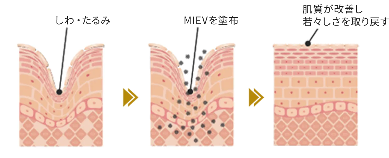 しみ・たるみ MEIVを浸透 角質が改善し若々しさを取り戻す